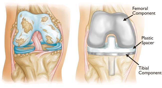Knee Replacement Surgery